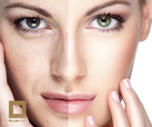 laser genesis belium somio estetica gijon